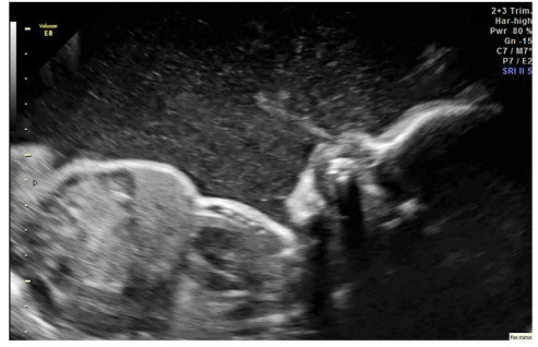Figure 1. . Intrauterine ultrasound at 32 weeks' gestation of fetus with IPEX syndrome showing desquamation with dense, echogenic amniotic fluid with particulate appearance and sediment layering, as well as echogenic debris in the stomach.
