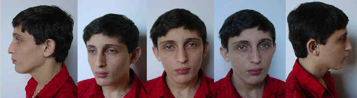 Figure 1. . Typical facial features of Alagille syndrome.