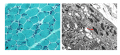 Figure 1. . Pathology of nemaline myopathy.
