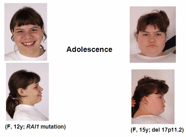 Figure 3. . Adolescent females with SMS caused by mutation of RAI1 (left) and deletion 17p11.