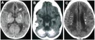 Figure 2. . Examples of intracranial calcification on CT scan in individuals with AGS.