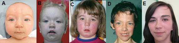 Figure 1. . Retrognathia present in younger children with EZH2-related overgrowth usually resolves with age.