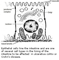 Image Crohn.jpg