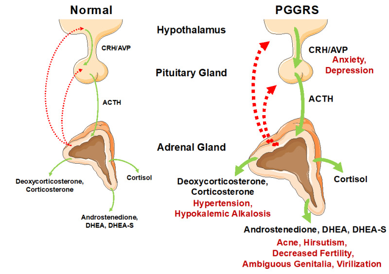 Figure 2. . Pathophysiologic mechanisms and clinical manifestations of primary generalized glucocorticoid resistance syndrome (PGGRS).