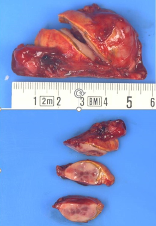 Figure 5. . Macroscopic photo of a right adrenal pheochromocytoma removed from the above patient with multiple endocrine neoplasia type 2.