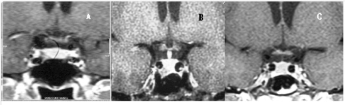 Figure 2. . A 32 yrs-old female patient with hyperprolactinemia (PRL 80 ng/mL), irregular menses and galactorrhea had a sellar MR showing a pituitary lesion of 0.