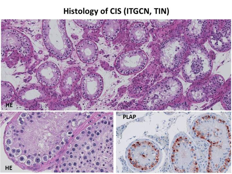 Figure 1. . Histology of germ cell neoplasia in situ (GCNIS).