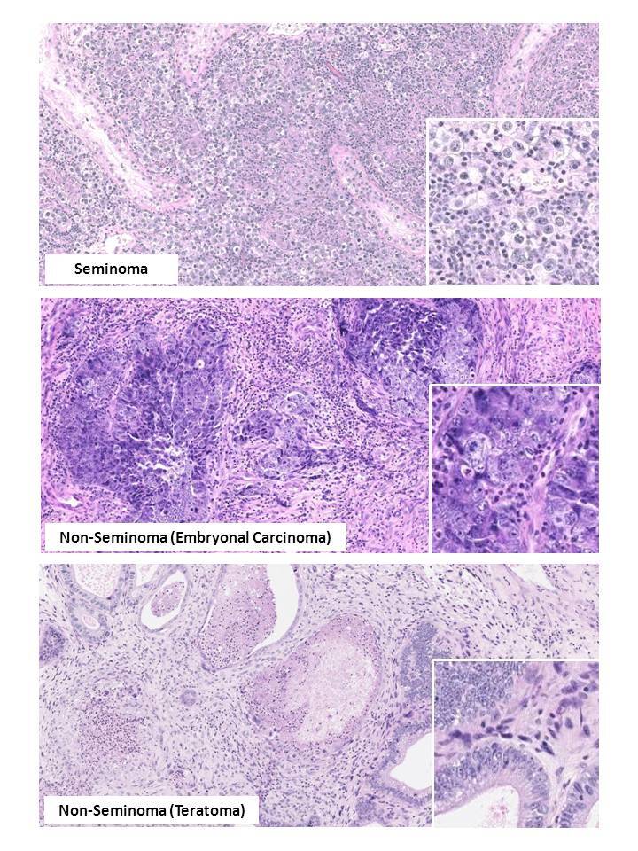 Figure 2. . Histology of main types of testicular germ cell tumors.
