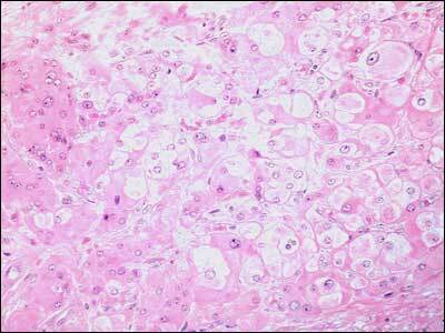 Figure 5. . Histology of a Leydig cell tumor.
