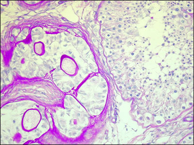 Figure 6. . Large cell calcifying Sertoli cell tumor isolated from a 12-year-old boy.
