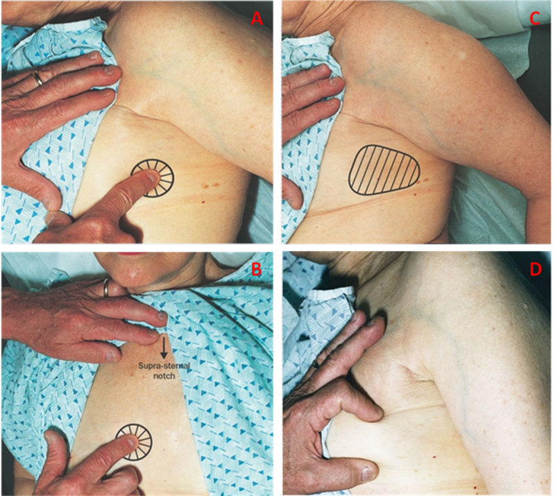 Figure 11. A. Focal chest wall pain—lateral. The patient is turned 90º on her side so that breast tissue is no longer under the area of palpation. The index finger elicits a focal area of pain. B. Focal chest wall pain over costochondral junctions anteriorly. C. Diffuse lateral chest wall pain. With the patient turned over 90 degrees on her side, pain is elicited over a wider area of the chest wall. D. Verification that squeezing breast tissue does not elicit pain ensures that the pain is not related to the breast but represents chest wall pain.