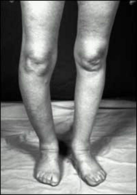 Figure 2. . Typical bowing of the leg due to Paget's disease involving the right tibia.