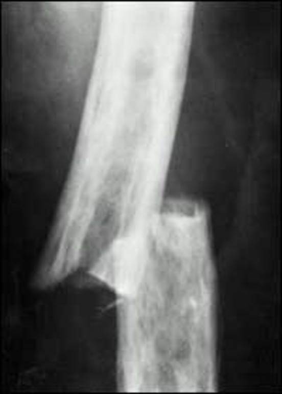 Figure 3. . Transverse fracture of the left femur.