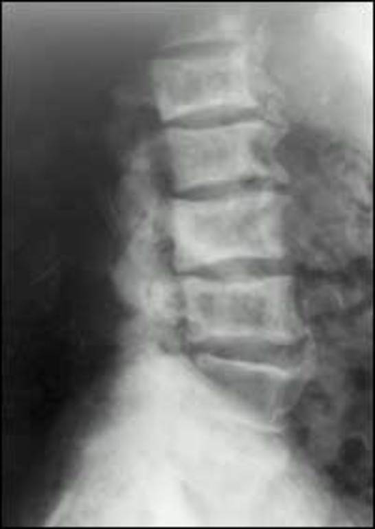 Figure 5. . Patient with back pain who has multiple vertebrae affected by Paget's disease, large osteophytes, and narrowed disc spaces.