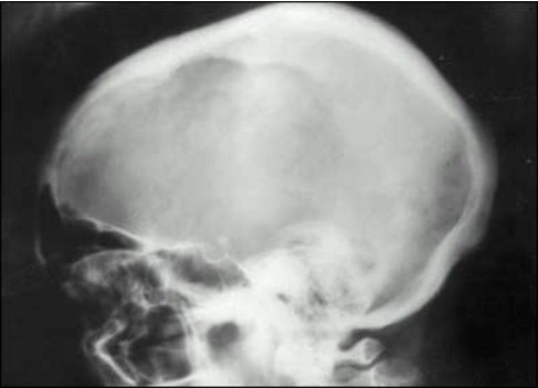 Figure 6. . Large osteolytic lesion in the skull of a woman with Paget's disease.