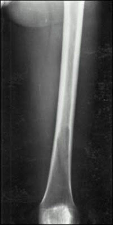 Figure 7. . Osteolytic lesion of the distal left femur which is progressing proximally.