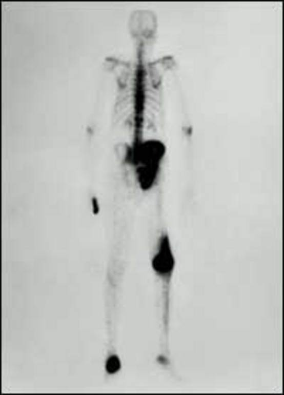 Figure 9. . A technetium 99m-bisphosphonate bone scan of a patient with polyostotic Paget's disease.