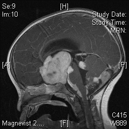 Figure 2. . T1-weighted MRI image demonstrating appearances of a large, lobulated optic pathway astrocytoma with hydrocephalus and widespread leptomeningeal dissemination affecting the brainstem, cerebellum, and spinal cord.