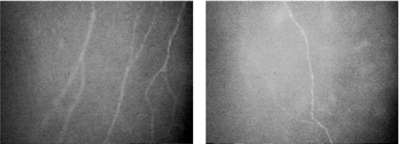 Figure 8. . Examples of corneal nerve fiber density in a patient with no diabetic neuropathy on the left and with established diabetic neuropathy on the right.
