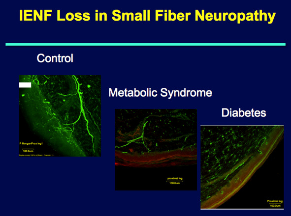 Figure 10. . Intraepidermal nerve fiber loss in small vessel neuropathy.