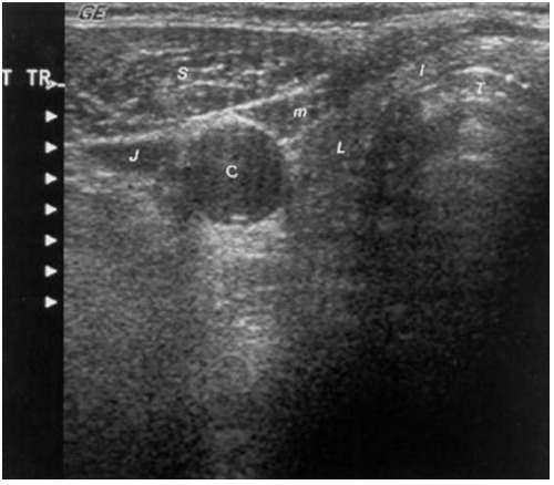 Figure 1. . Sonogram of the neck in the transverse plane showing a normal right thyroid lobe and isthmus.