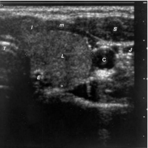 Figure 2. . Sonogram of the left lobe of the thyroid gland in the transverse plane showing a rounded lobe of a goiter.