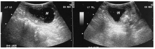 Figure 3. . Sonograms showing longitudinal (left panel) and transverse (right panel) images of the left lobe containing a degenerated thyroid nodule.