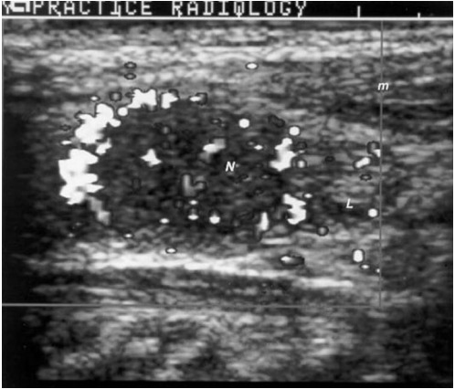 Figure 5. . Sonogram of the neck in the longitudinal plane showing a hypoechogenic nodule that was surrounded by an echo free rim, called a halo.