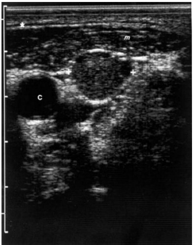 Figure 8. . Sonogram in the transverse plane after thyroidectomy for cancer, from a muscular man.