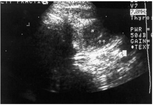 Figure 9. . Sonogram from an ultrasound guided fine needle aspiration biopsy showing a hypoechoic small nodule.