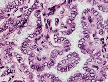 Figure 18-9. A) Papillary carcinoma of the thyroid.
