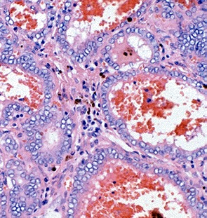 Figure 18-9. B) Follicular variant of papillary carcinoma with more typical vesicular nuclei, and hemorrhage in follicular lumens.