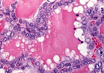 Figure 18-9. C) Follicular variant of papillary carcinoma with crowded nuclei showing nuclear folding and peripherally vacuolated colloid.
