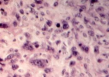 Figure 18-9. E) An anaplastic carcinoma of the thyroid with pleomorphic giant tumor cell nuclei.