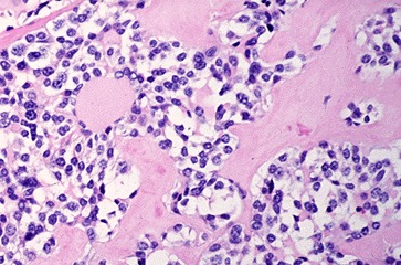 Figure 18-9. F) Medullary (C-cell) carcinoma of the thyroid with amyloid stroma.