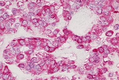 Figure 18-9. G) Immunohistochemical anti-calcitonin antibody stain of a medullary carcinoma showing strong red positivity.