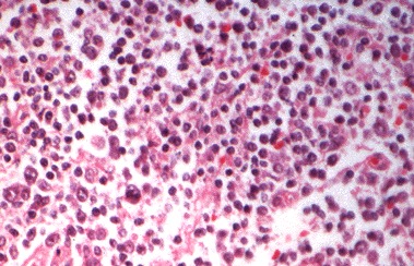Figure 18-9. H) Large cell lymphoma of the thyroid.