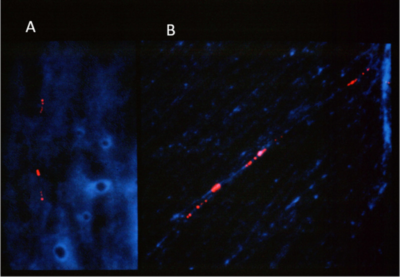 Figure 3. . Hybridization in prometaphase chromosomes of cultured skin fibroblasts obtained from an affected male with TBG-E.