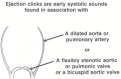 Figure 28.1. The ejection click occurs at the moment of maximal opening of the valve.