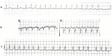 Figure 33.16. Three varieties of supraventricular tachycardia: Paroxysmal supraventricular tachycardia, initiated by a premature atrial complex.