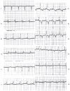 Figure 33.22. Right ventricular hypertrophy due to tetralogy of Fallot, with equalization of right and left ventricular pressures.