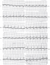 Figure 33.23. Right ventricular predominance due to mitral stenosis, with coexistent left atrial abnormality.