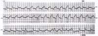 Figure 33.6. Accelerated idioventricular rhythm due to augmented automaticy.
