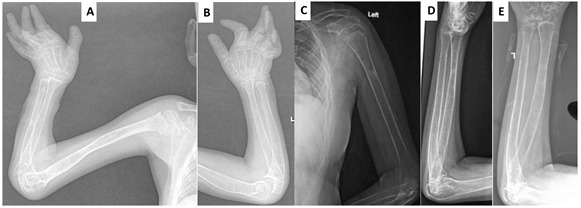 Figure 6. . Radiographs of the long bones of the upper extremities in affected individuals at ages 6 years (A, B) and 13 years (C, D, E).