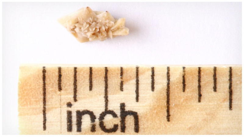 Kidney stones can range in size and shape.