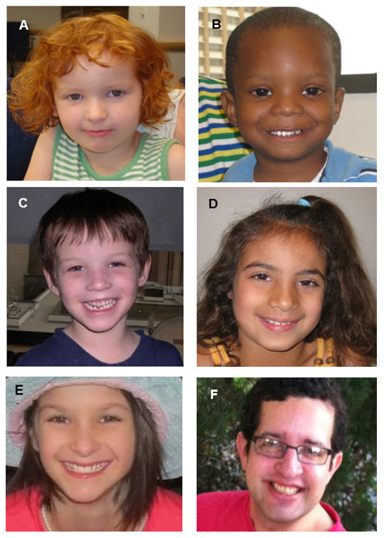 Figure 1. . Individuals with Potocki-Lupski syndrome.