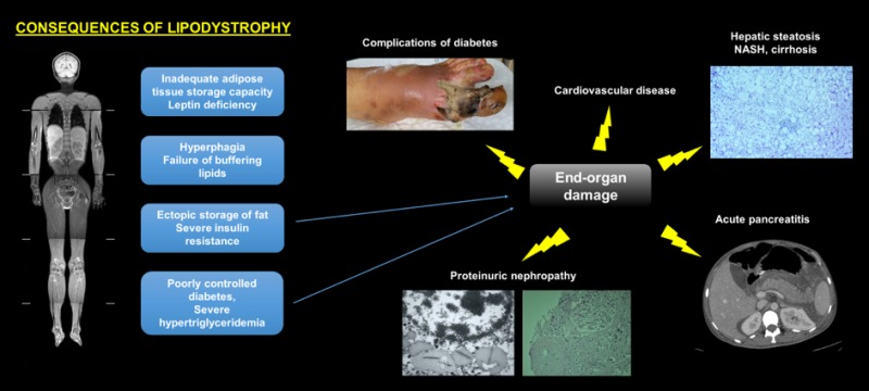 Figure 1. Consequences of Lipodystrophy: The figure summarizes metabolic derangements and end-organ complications in patients with lipodystrophy (Left: MRI showing near total lack of adipose tissue; Right top: Liver biopsy shows hepatic steatosis in lipodystrophy (Hematoxylin and eosin staining; magnification 100X), Right bottom: CT of abdomen obtained during an episode of acute pancreatitis in lipodystrophy; Middle top: Diabetic foot ulcer in a patient with generalized lipodystrophy; Middle bottom: Renal biopsy specimens (Left: Electron microscopy image reveals lipid vacuoles which suggest ectopic lipid accumulation; Right: Light microscopy image documents chronic kidney disease in lipodystrophy (Hematoxylin and eosin staining; magnification 40X).