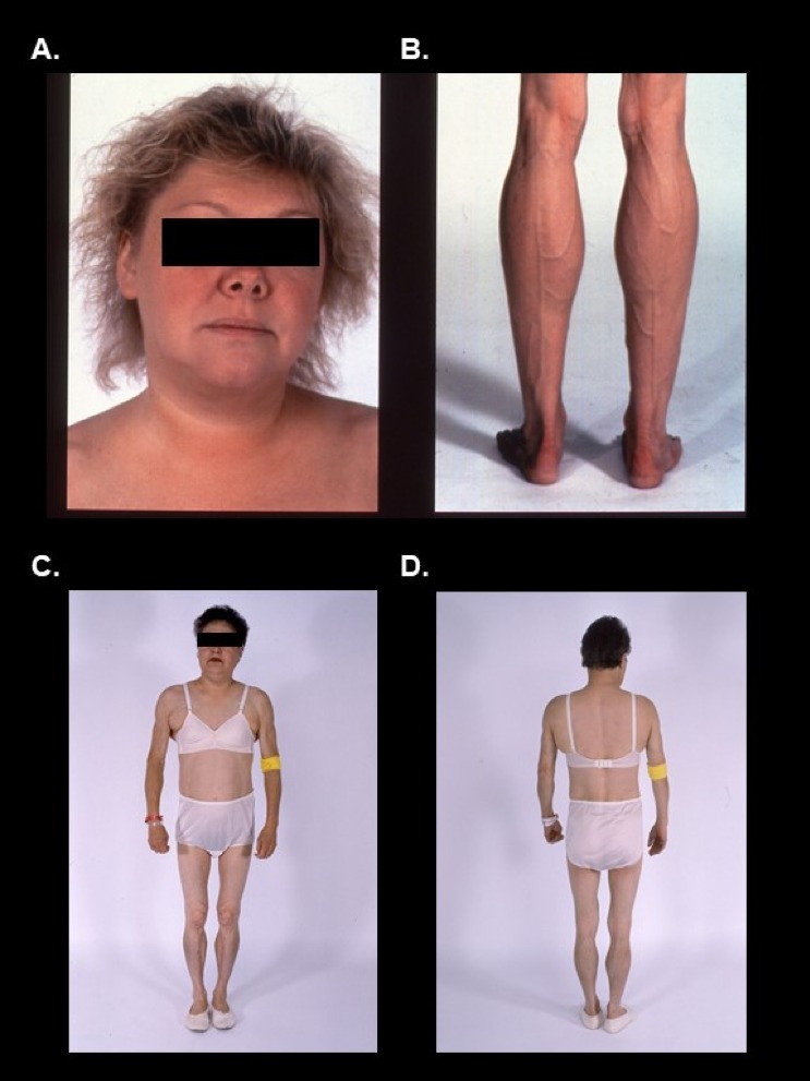 Figure 10. Subcutaneous adipose tissue loss from the extremities, excess fat accumulation in the face and neck, and Cushingoid appearance in FPLD2 (10A-D; Note that one of the patients (10A) previously underwent liposuction for removal of unwanted excess fat from the neck).