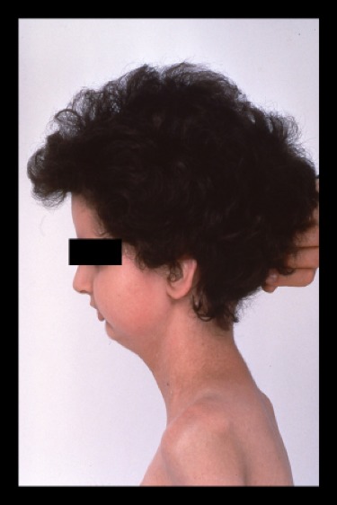 Figure 12. Hypoplasia of the mandible in a patient with Mandibuloacral Dysplasia.