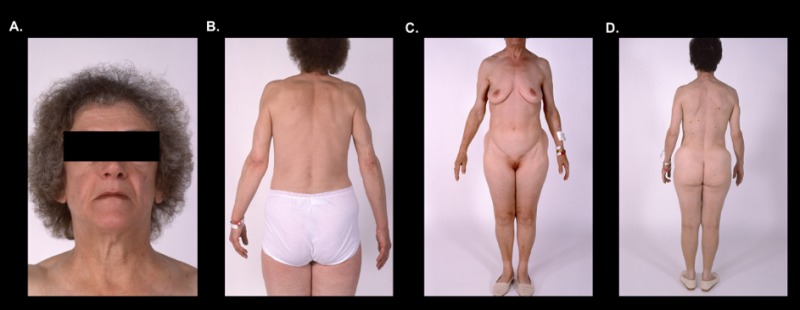 Figure 16. Typical cephalocaudal adipose tissue loss pattern in two patients with APL (16A-D).